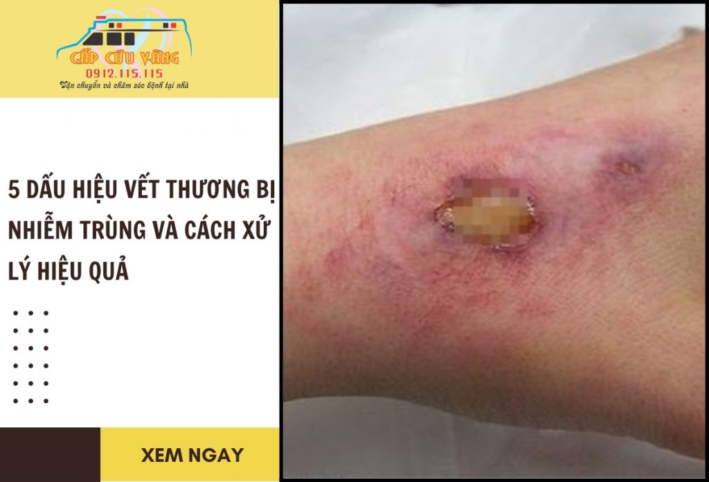Dấu hiệu vết thương nhiễm trùng